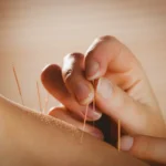 young-woman-getting-acupuncture-treatment