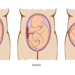 Baby positions in pregnancy