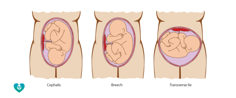 Baby positions in pregnancy